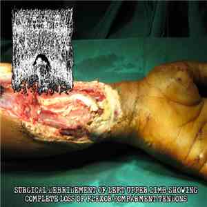 MxOxPxCxBxIxTxIxLxOxTxBxVx - Surgical Debridement Of Left Upper Limb Showing Complete Loss Of Flexor Comparment Tendons album flac